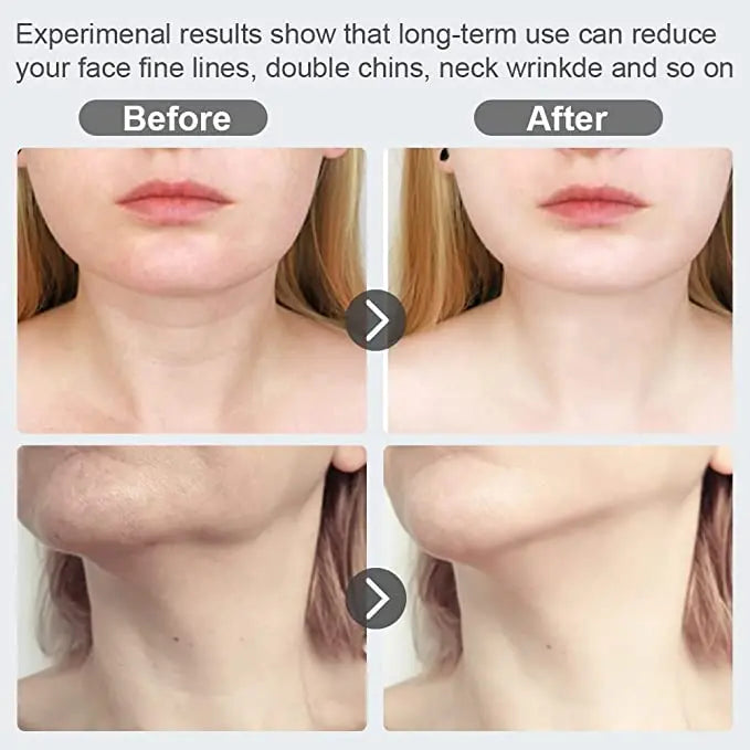 Skin Rejuvenation Beauty Device, Firming Wrinkle Removal Device