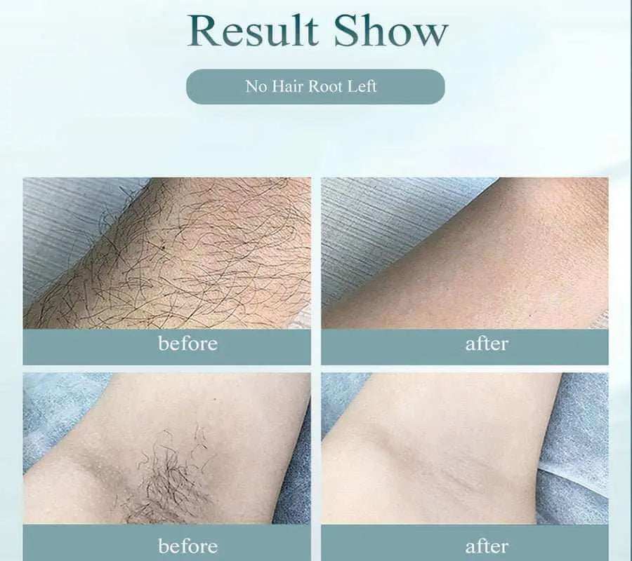 Laser At-Home IPL Hair Removal 